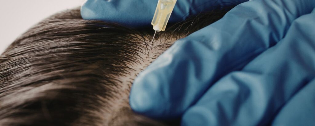 Stem Cell Hair Restoration