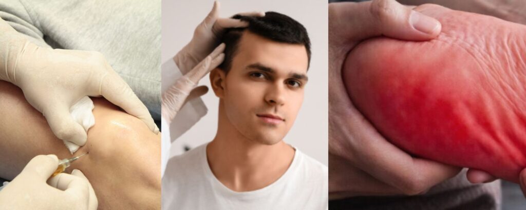 Stem Cell Therapy for Other Areas